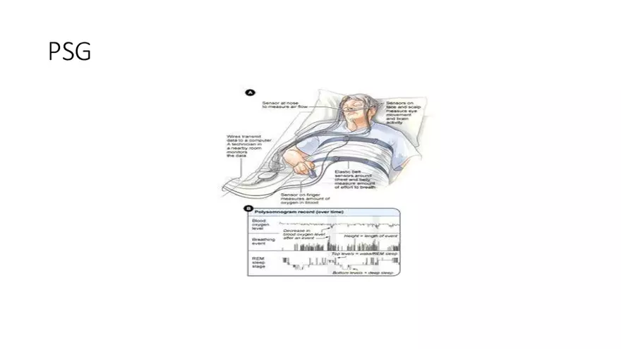 Obstructive Sleep Apnea Obesity Hypoventilation Syndrome - Page 7
