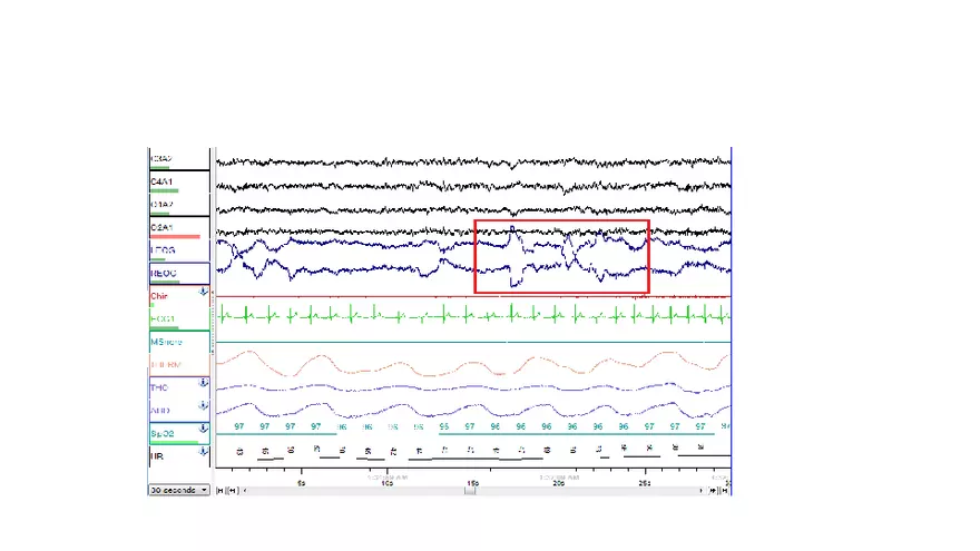 Obstructive Sleep Apnea Obesity Hypoventilation Syndrome - Page 9