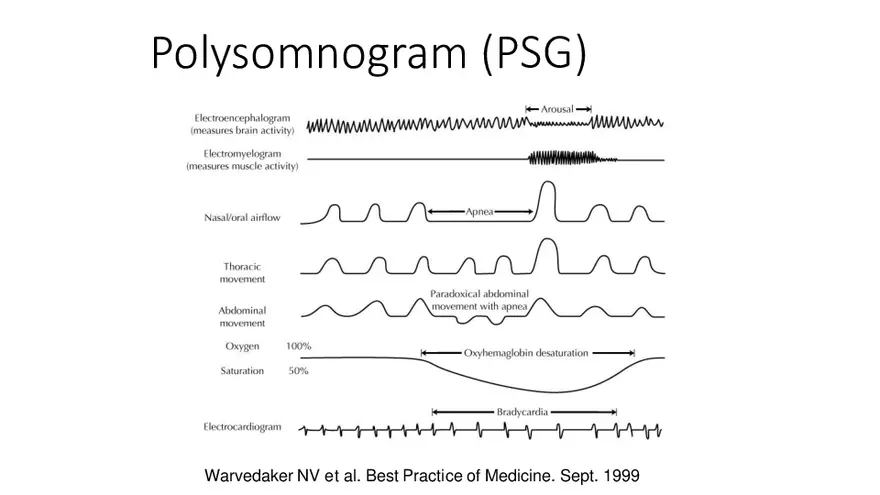 Obstructive Sleep Apnea Obesity Hypoventilation Syndrome - Page 10