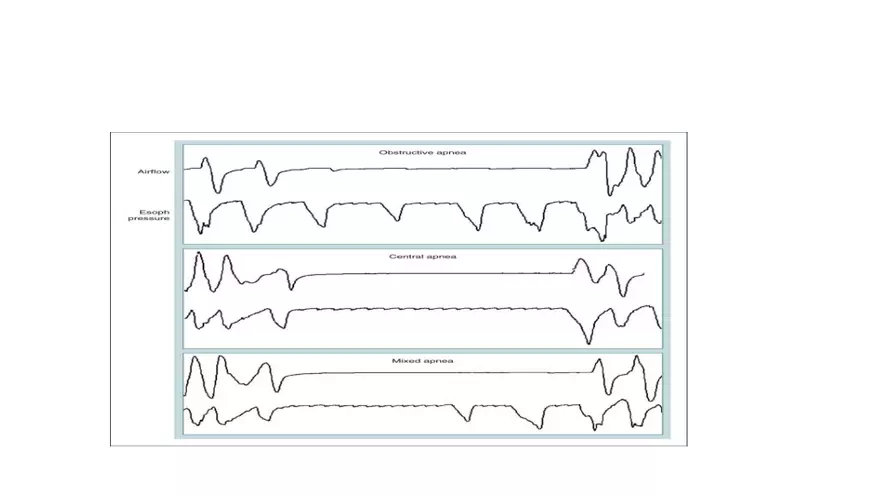 Obstructive Sleep Apnea Obesity Hypoventilation Syndrome - Page 16