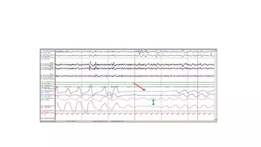 Obstructive Sleep Apnea Obesity Hypoventilation Syndrome - Page 17