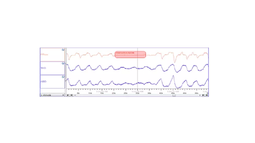 Obstructive Sleep Apnea Obesity Hypoventilation Syndrome - Page 18