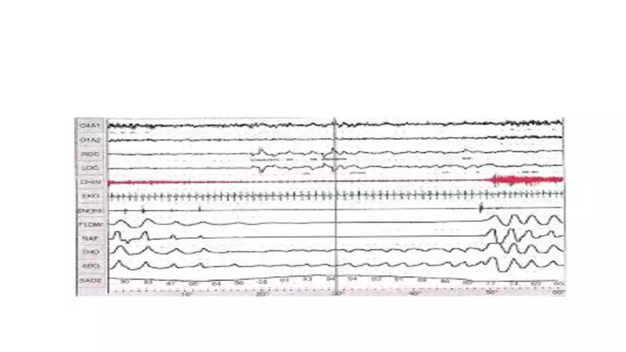 Obstructive Sleep Apnea Obesity Hypoventilation Syndrome - Page 19
