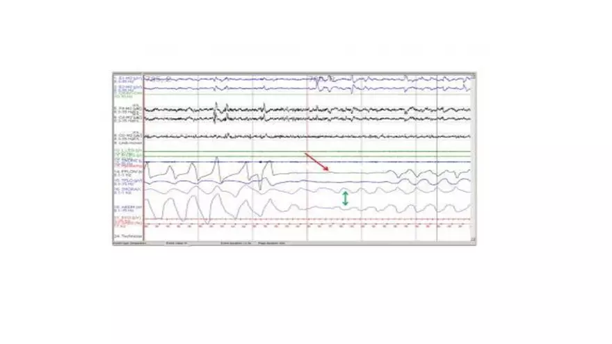Obstructive Sleep Apnea Obesity Hypoventilation Syndrome - Page 20