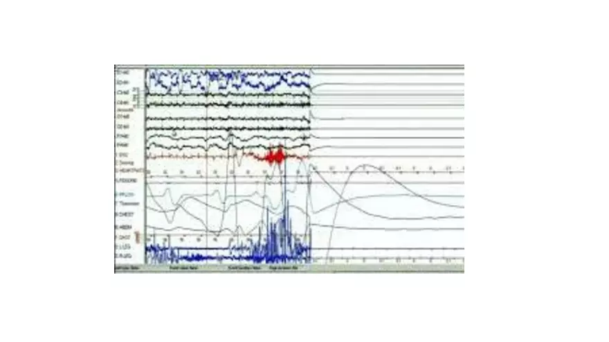 Obstructive Sleep Apnea Obesity Hypoventilation Syndrome - Page 21