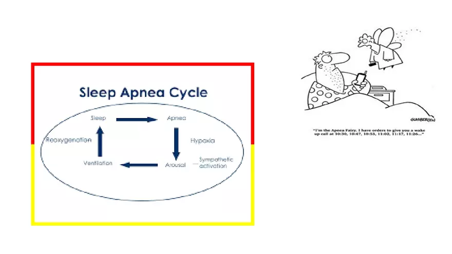 Obstructive Sleep Apnea Obesity Hypoventilation Syndrome - Page 24
