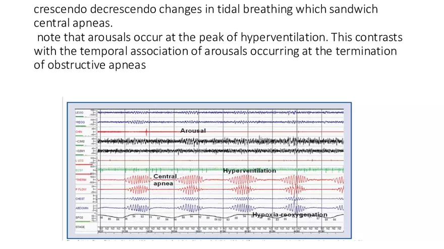 Obstructive Sleep Apnea Obesity Hypoventilation Syndrome - Page 25