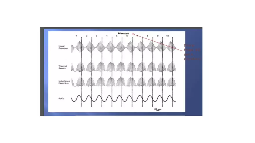 Obstructive Sleep Apnea Obesity Hypoventilation Syndrome - Page 27