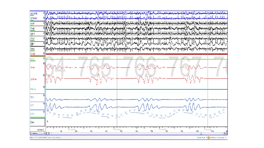 Obstructive Sleep Apnea Obesity Hypoventilation Syndrome - Page 30