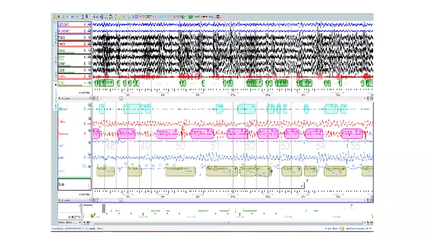 Obstructive Sleep Apnea Obesity Hypoventilation Syndrome - Page 32