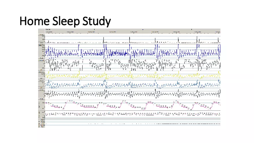 Obstructive Sleep Apnea Obesity Hypoventilation Syndrome - Page 34