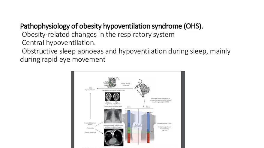 Obstructive Sleep Apnea Obesity Hypoventilation Syndrome - Page 50
