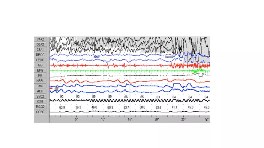 Obstructive Sleep Apnea Obesity Hypoventilation Syndrome - Page 52