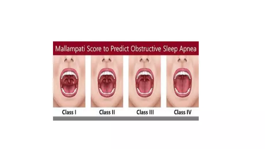 Obstructive Sleep Apnea Obesity Hypoventilation Syndrome - Page 56
