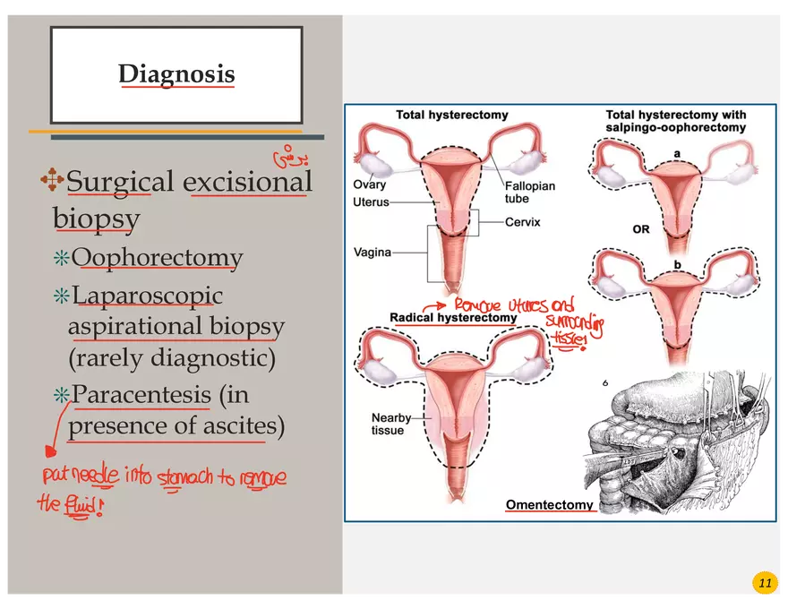 Ovarian Cancer Presentation - Page 13