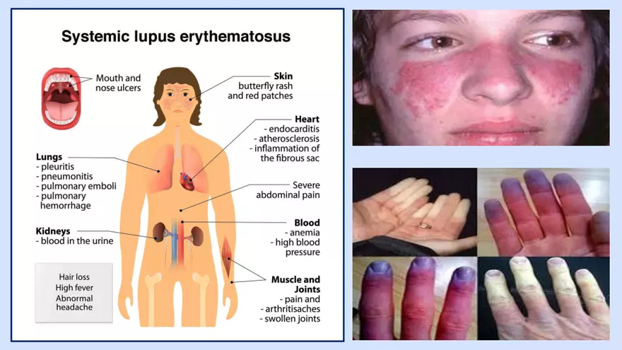 Systemic Lupus Erythematosus - Page 37