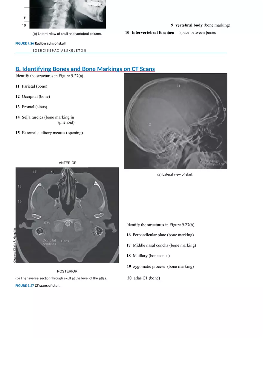 Identifying Bones and Bone Markings on Radiographs of Skull - Page 2
