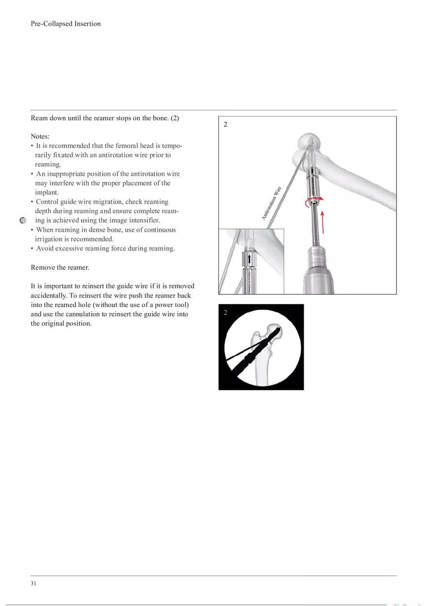 Femoral Neck Checking Option Pre-Collapsed Insertion - Page 2