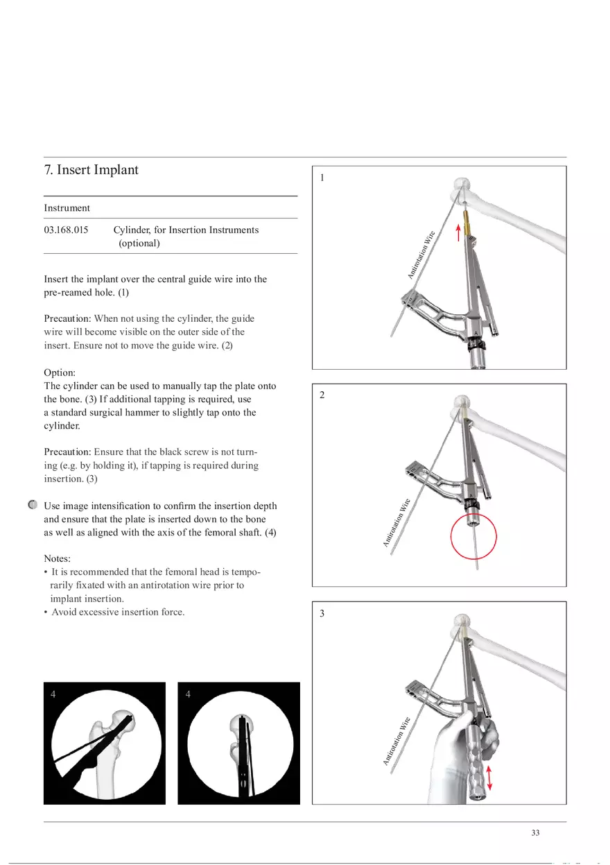 Femoral Neck Checking Option Pre-Collapsed Insertion - Page 5
