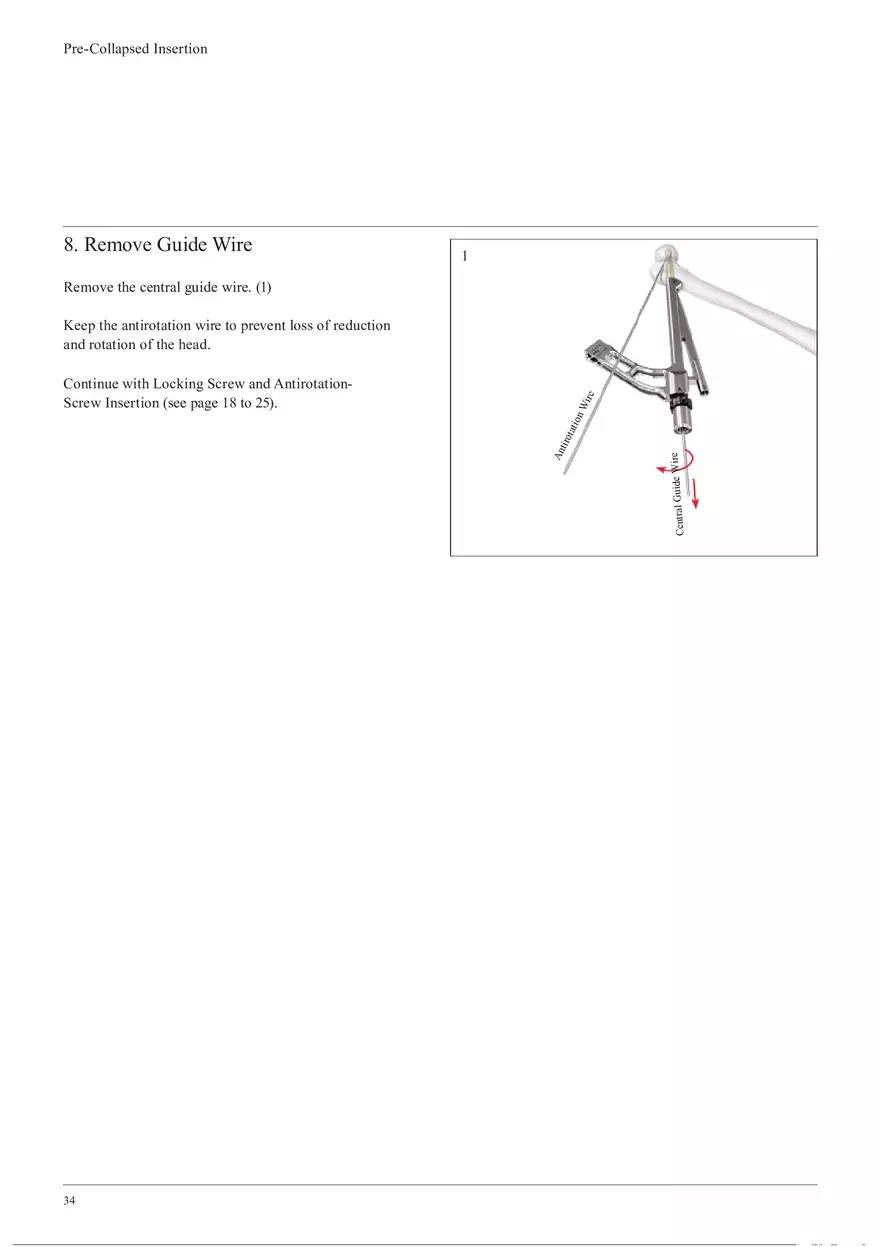 Femoral Neck Checking Option Pre-Collapsed Insertion - Page 6