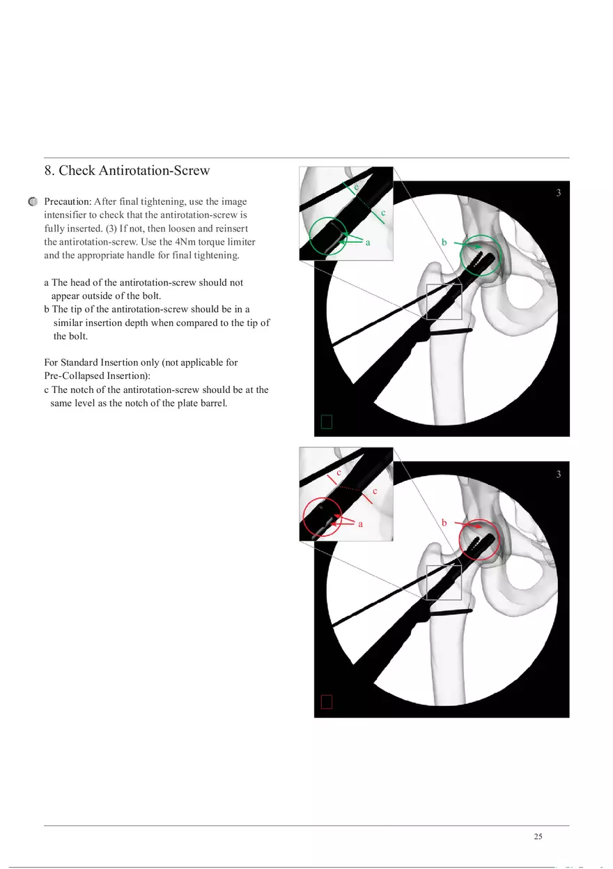 Femoral Neck System Locking Screw and Antirotation-Screw Insertion - Page 8