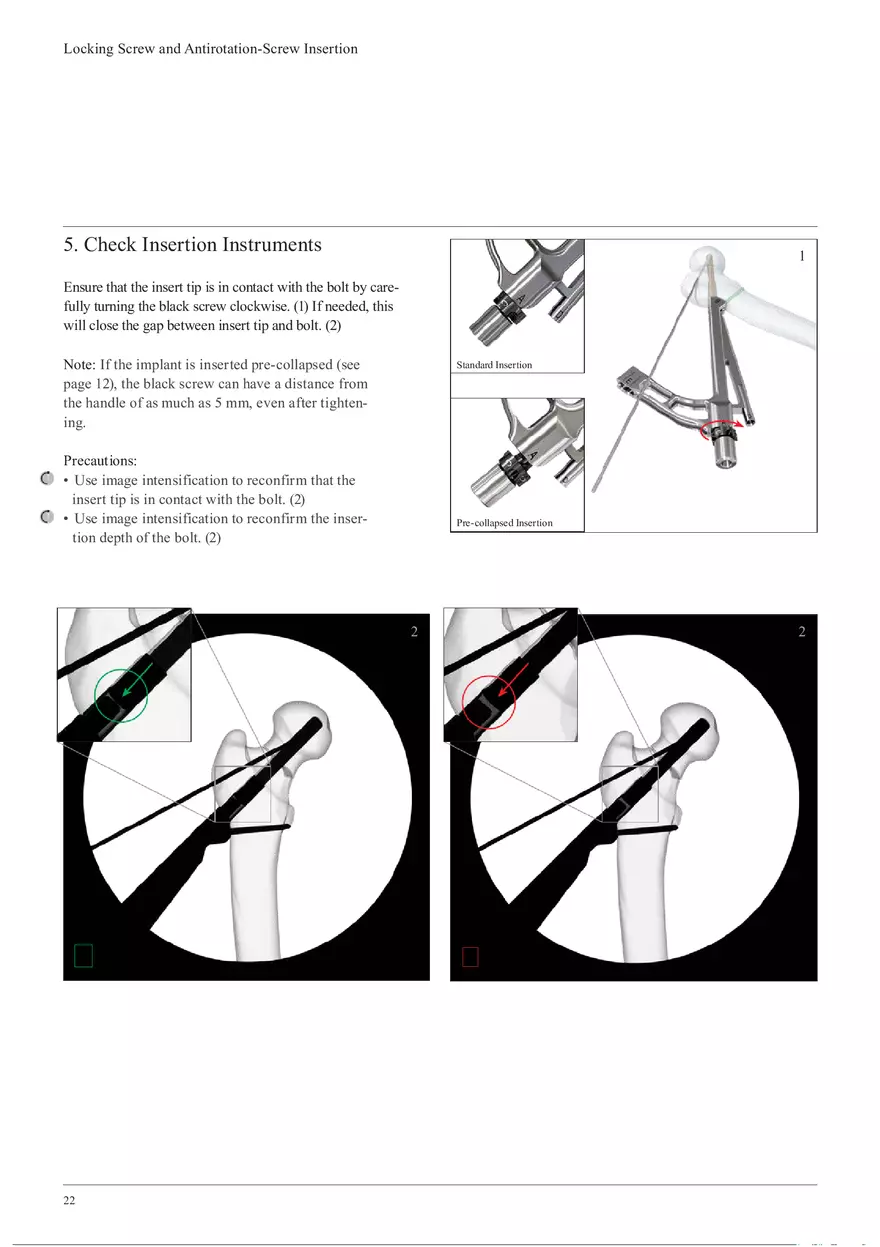 Femoral Neck System Locking Screw and Antirotation-Screw Insertion - Page 5