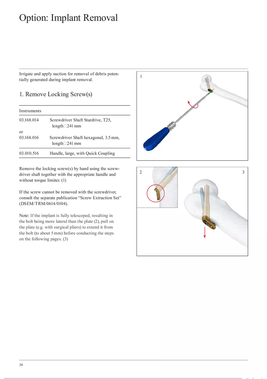 Femoral Neck Checking Option Implant Removal - Page 1