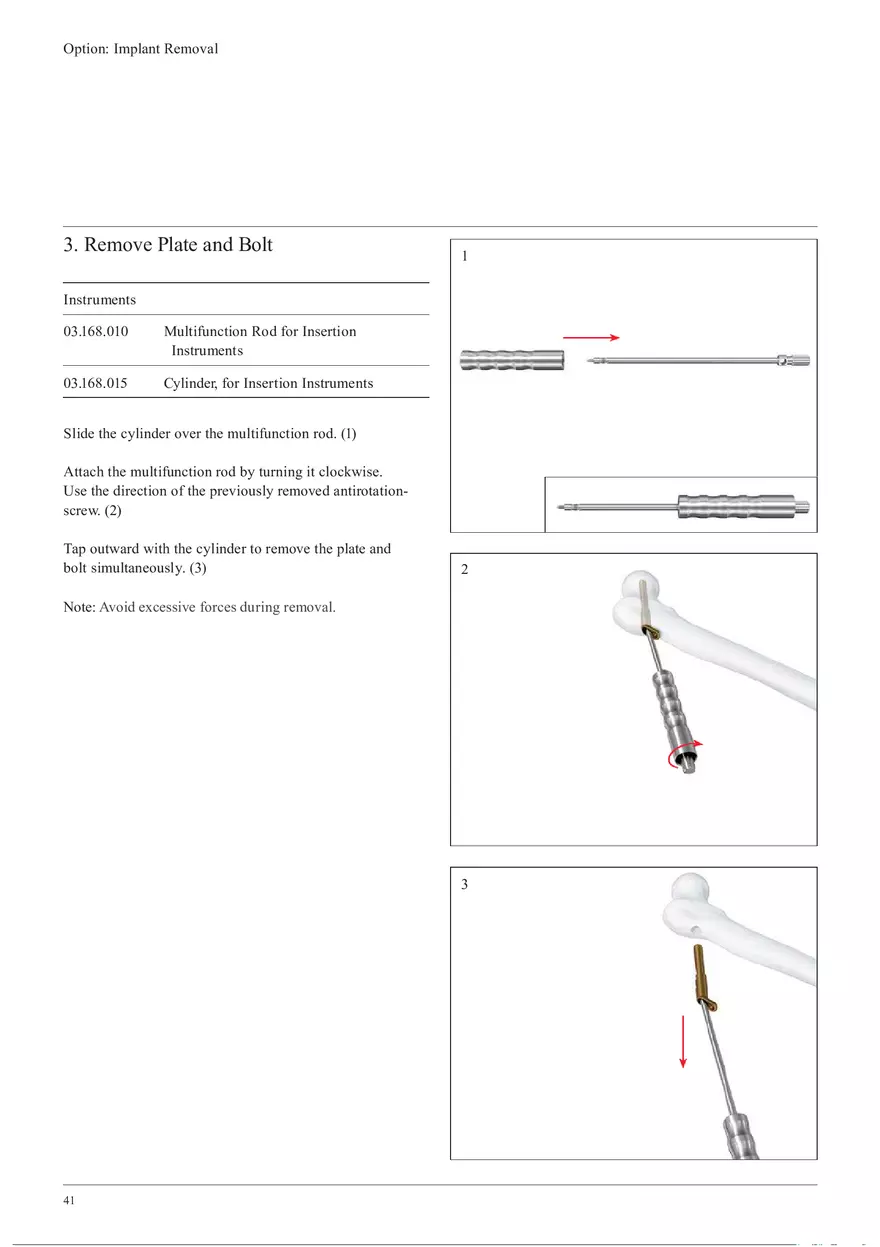 Femoral Neck Checking Option Implant Removal - Page 3
