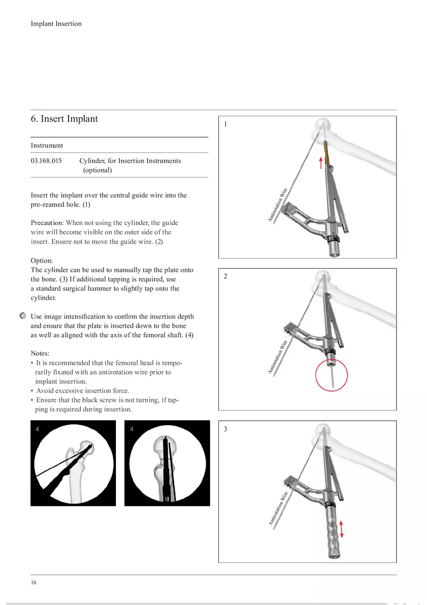 Femoral Neck System Implant Insertion - Page 8