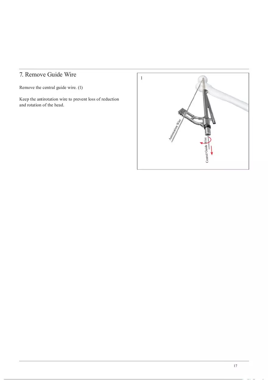 Femoral Neck System Implant Insertion - Page 9