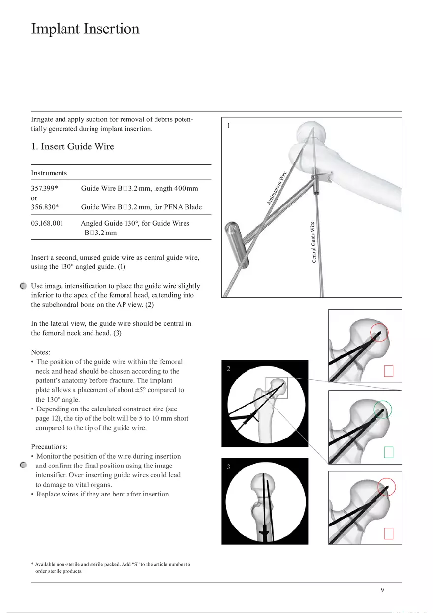 Femoral Neck System Implant Insertion - Page 1
