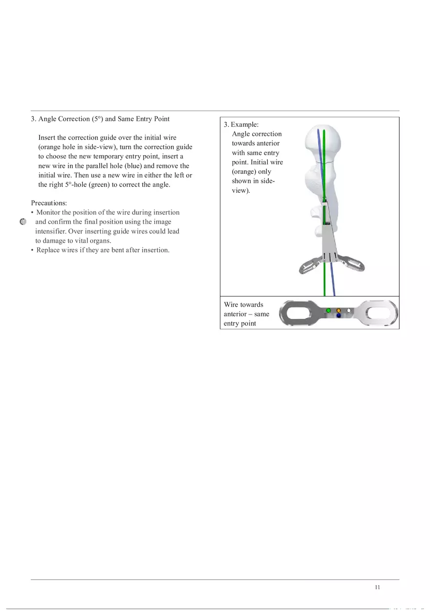 Femoral Neck System Implant Insertion - Page 3