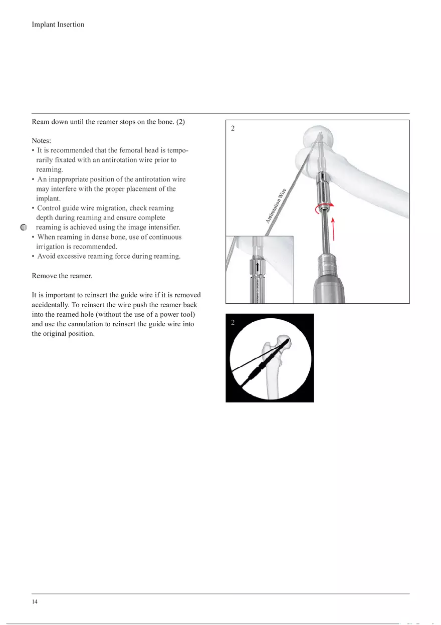 Femoral Neck System Implant Insertion - Page 6
