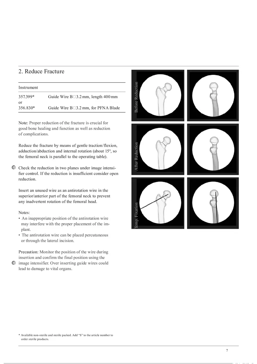 Femoral Neck System Preparation - Page 2