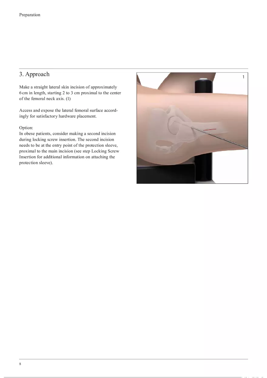 Femoral Neck System Preparation - Page 3