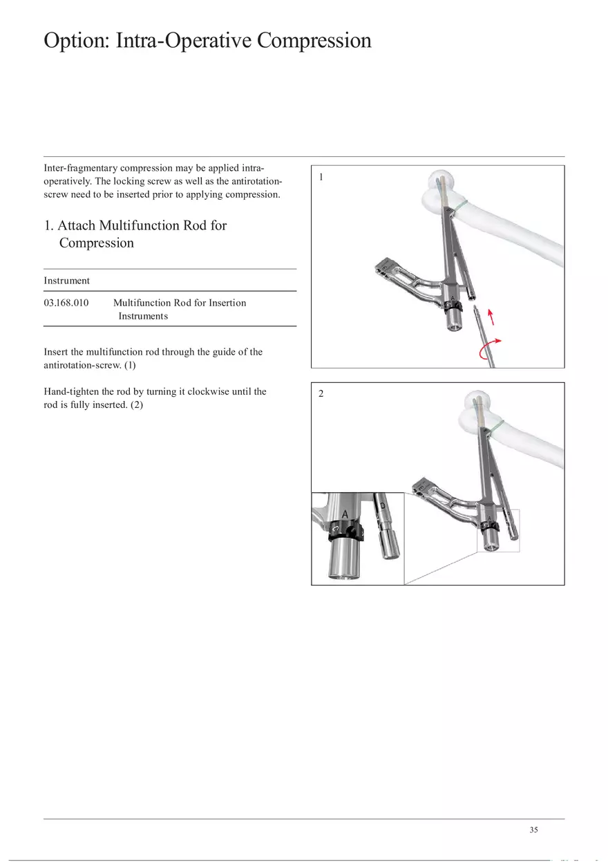 Femoral Neck Checking Option Intra-Operative Compression - Page 1