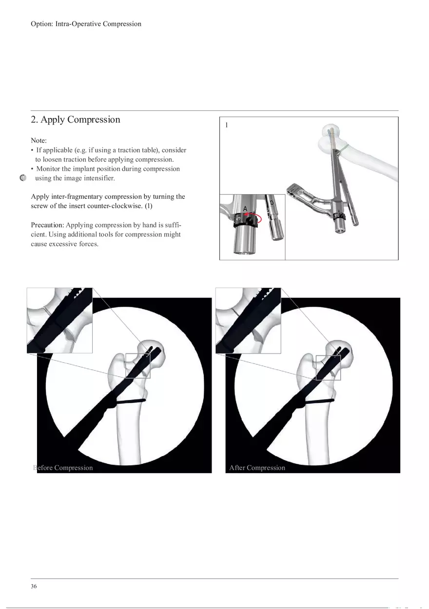Femoral Neck Checking Option Intra-Operative Compression - Page 2