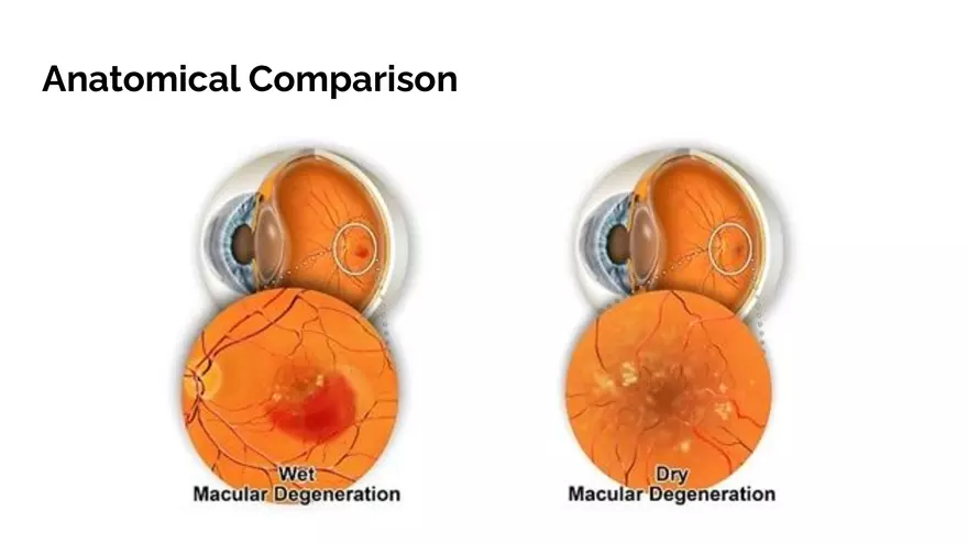 Understanding Macular Degeneration - Page 9