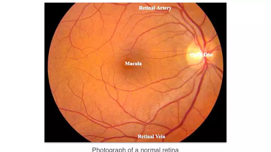 Understanding Macular Degeneration - Page 10