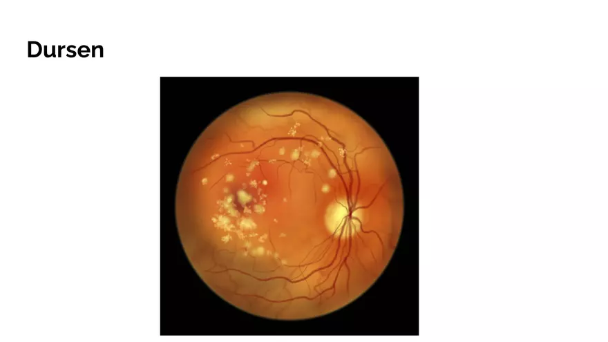 Understanding Macular Degeneration - Page 11