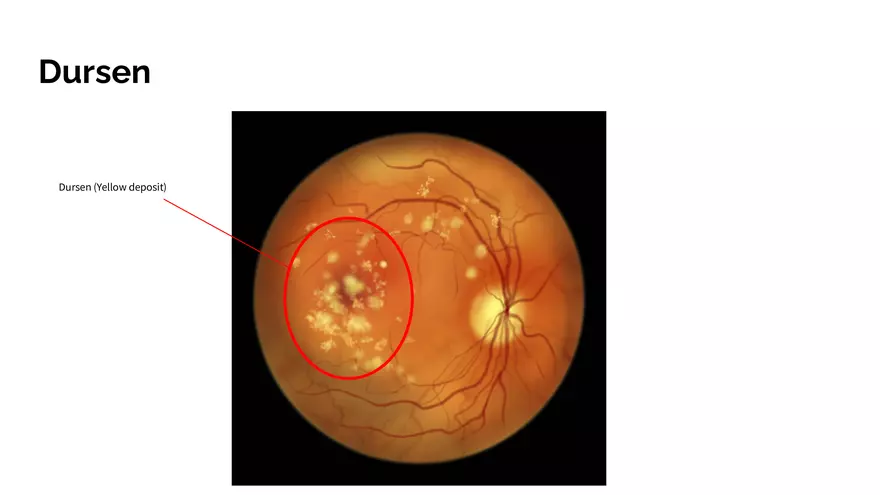 Understanding Macular Degeneration - Page 12