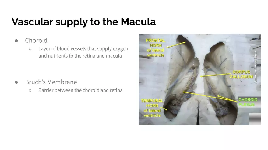 Understanding Macular Degeneration - Page 6