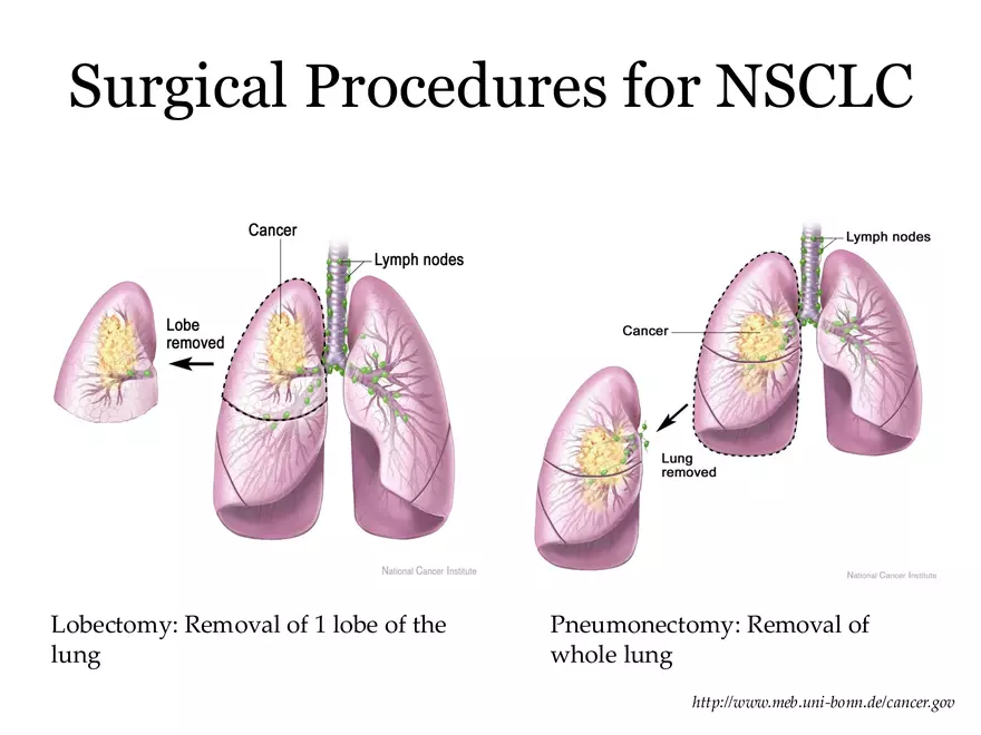 Lung Cancer Study Guide - Page 25
