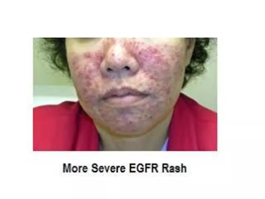 Lung Cancer Study Guide - Page 65