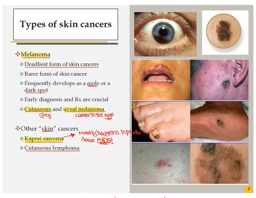 Skin Cancers Study Notes - Page 35