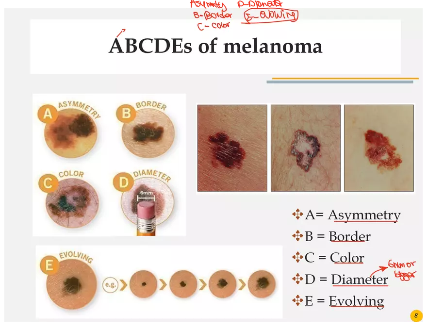 Skin Cancers Study Notes - Page 38