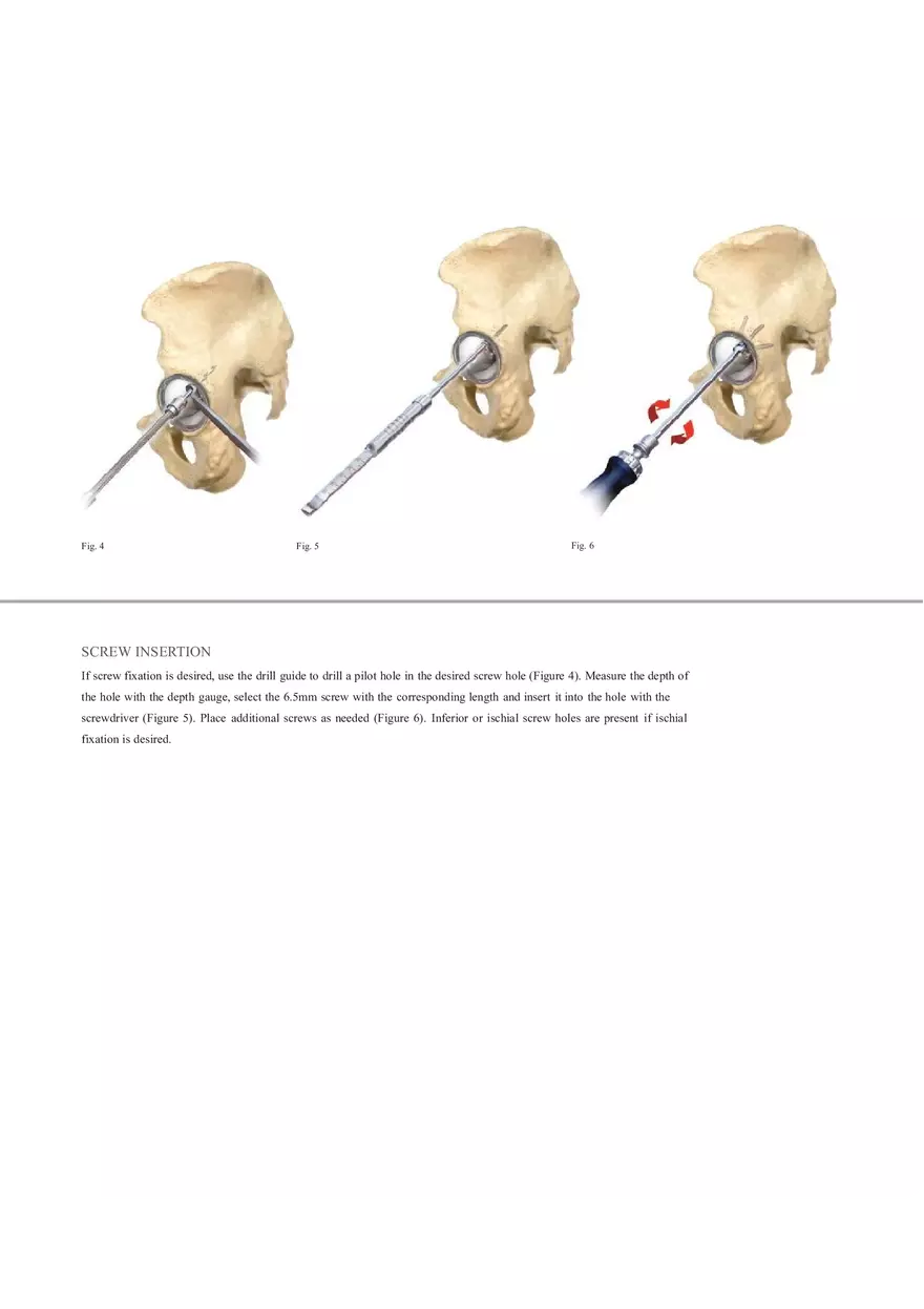 Regenerex Ringloc Surgical Technique - Page 10