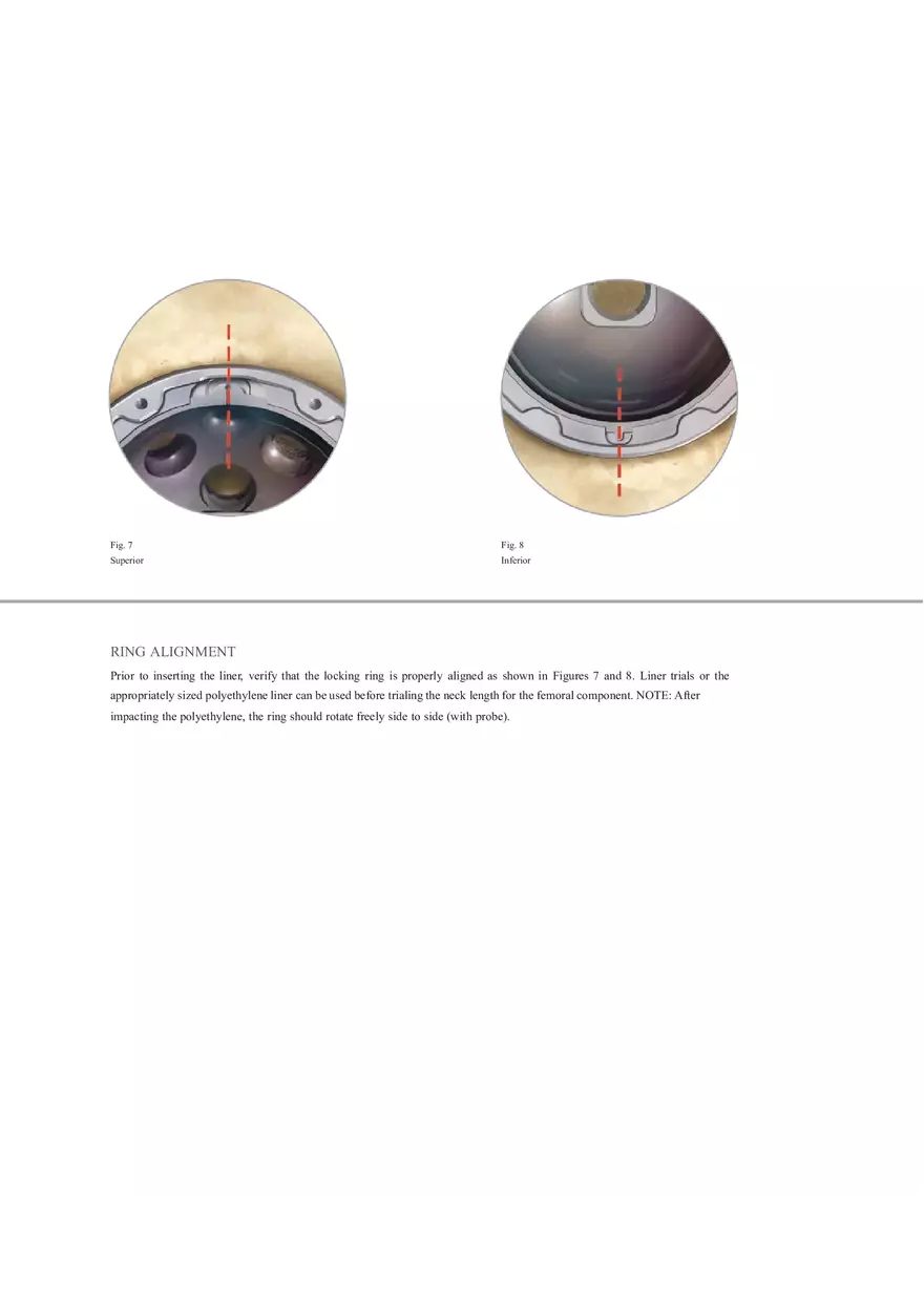 Regenerex Ringloc Surgical Technique - Page 11