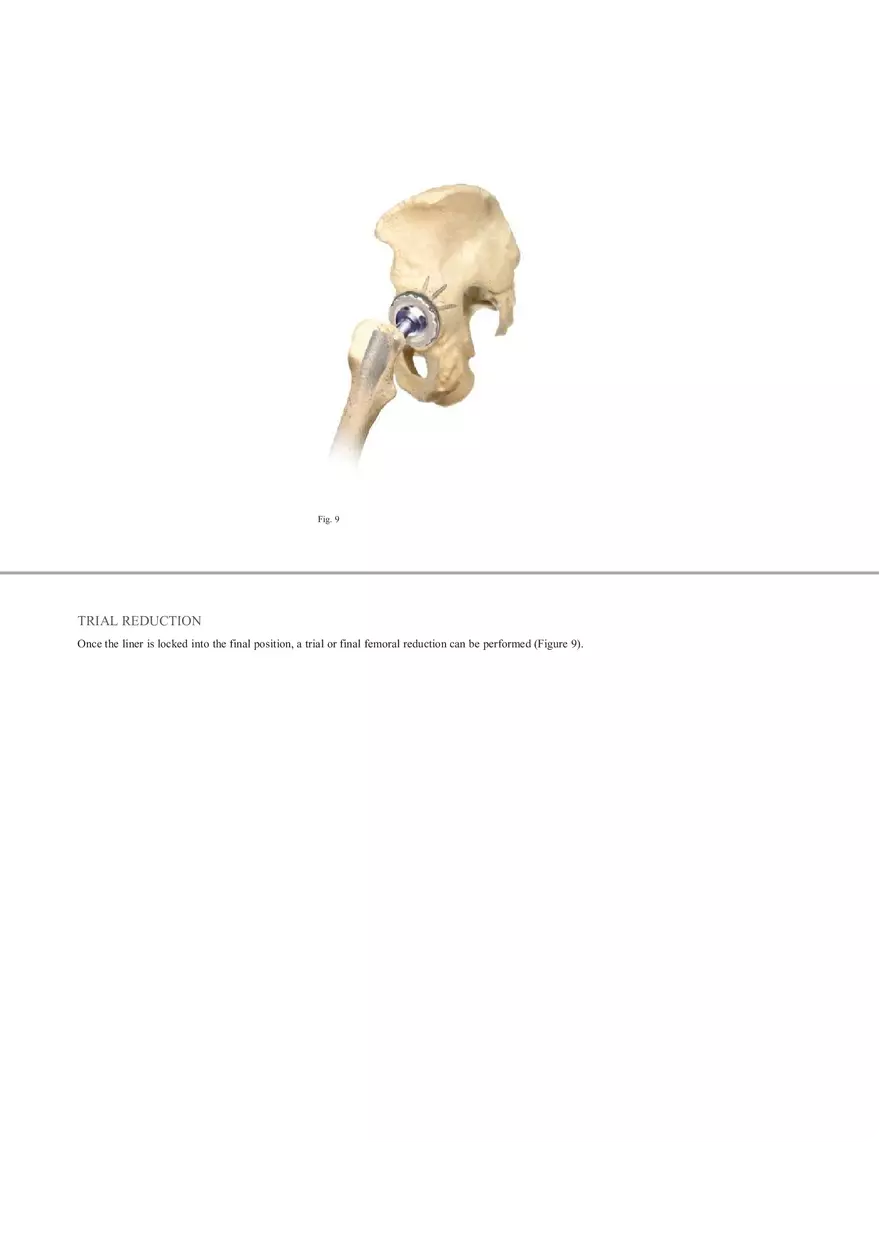 Regenerex Ringloc Surgical Technique - Page 12