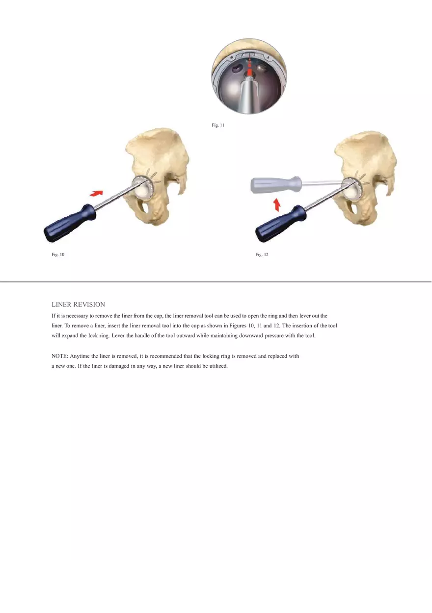 Regenerex Ringloc Surgical Technique - Page 13